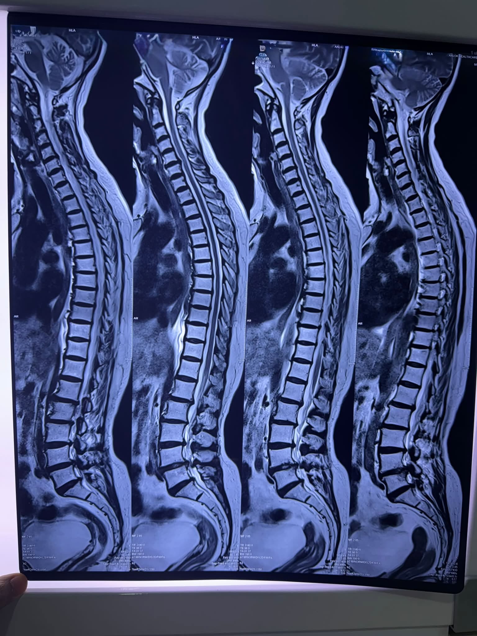 PLID / Disc Bulge / Disc Herniation / Disc Protrusion/ Degenerative Disc